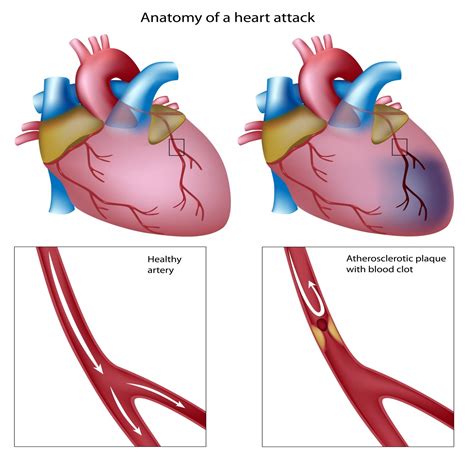 Cardiac infraction