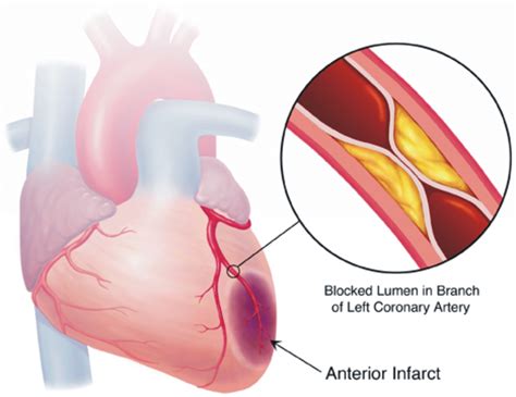 Cardiac ischemia