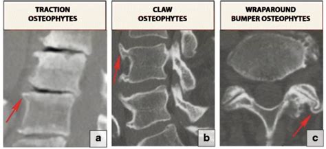 Causes and Risk Factors of Disc Osteophyte Complex Formation