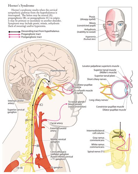 Causes of Horner's Syndrome