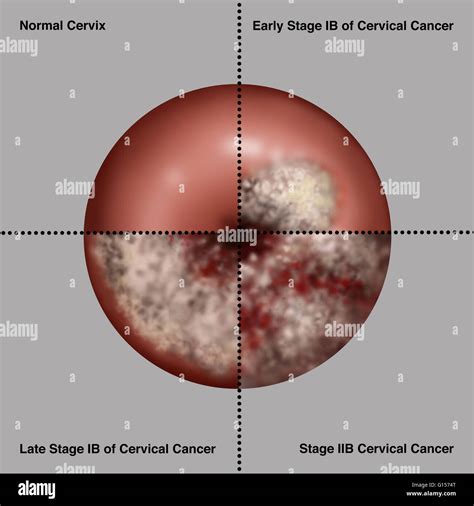 Description of Cervical Cancer