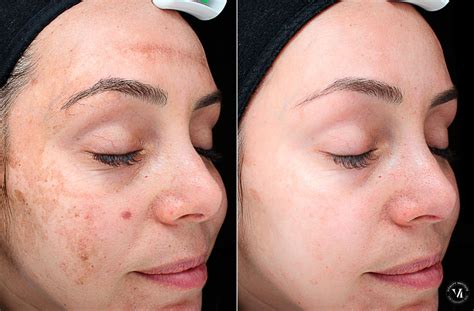 Chemical peels procedure