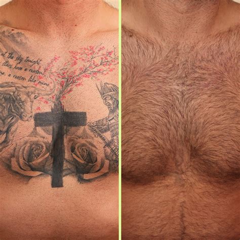 Chest tattoo removal options