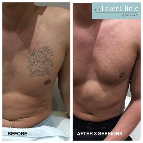 Chest tattoo removal cost