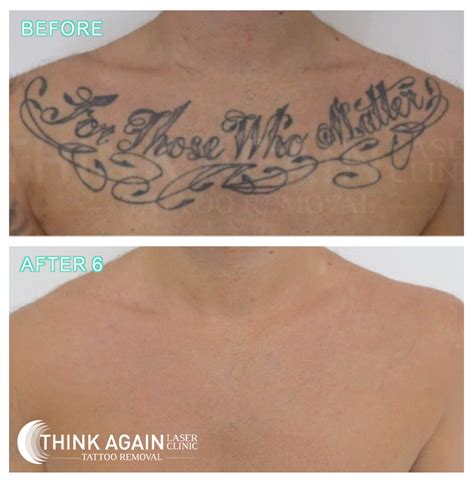 Chest tattoo removal for women