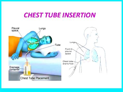 Chest tube insertion