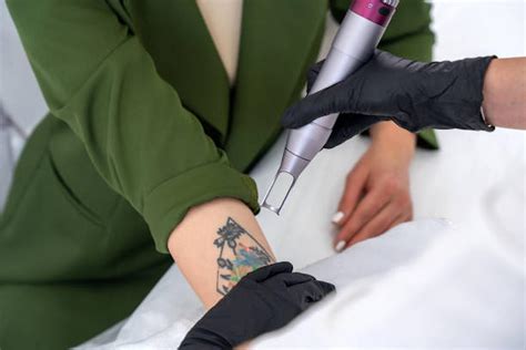 Choosing the right tattoo removal expert