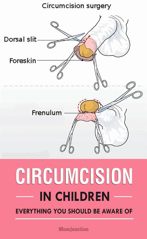 Circumcision Methods and Costs