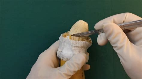 Description of Circumcision Procedure