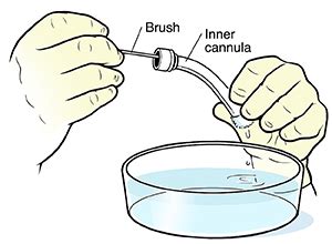 Cleaning the tracheostomy tube with a saline solution