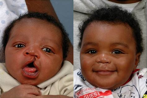 cleft palate image