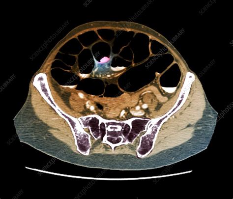 Colon Cancer CT Scan