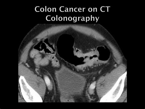 Colon Cancer Imaging Techniques