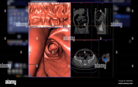 Colon Cancer Imaging Techniques