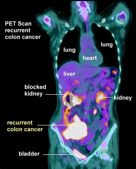 Colon Cancer PET Scan