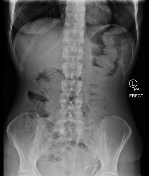 Colon Cancer X-Ray