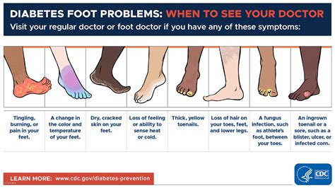 Common foot problems in diabetics