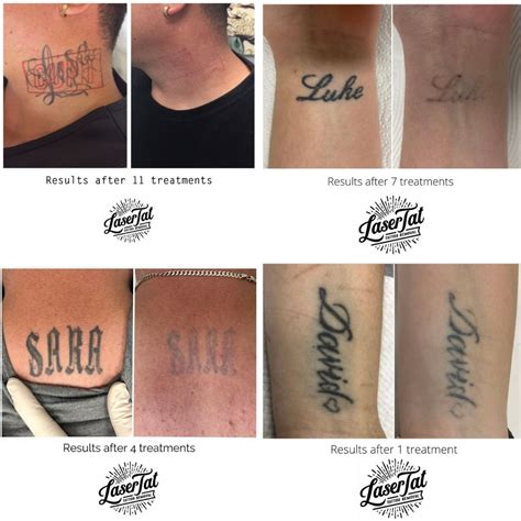 Common questions about tattoo removal