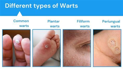 Common Types of Warts