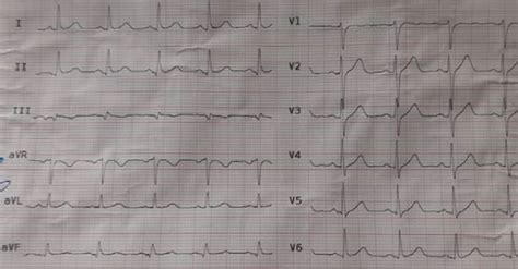 Complications of ECG pattern