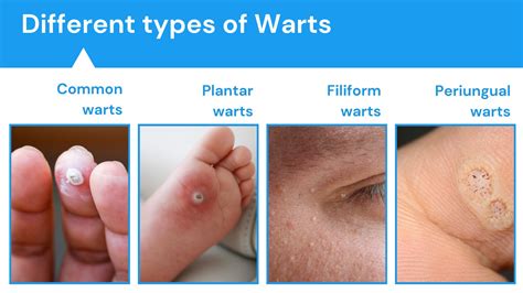 Complications of Warts