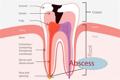 Complications of wisdom tooth abscess