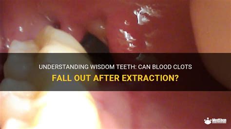 Complications of wisdom tooth clot formation