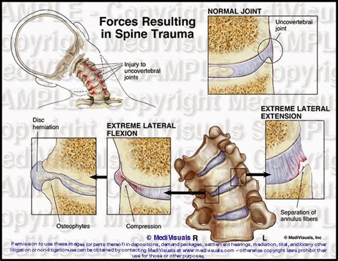 Conclusion and Final Thoughts on Disc Osteophyte Complex Formation