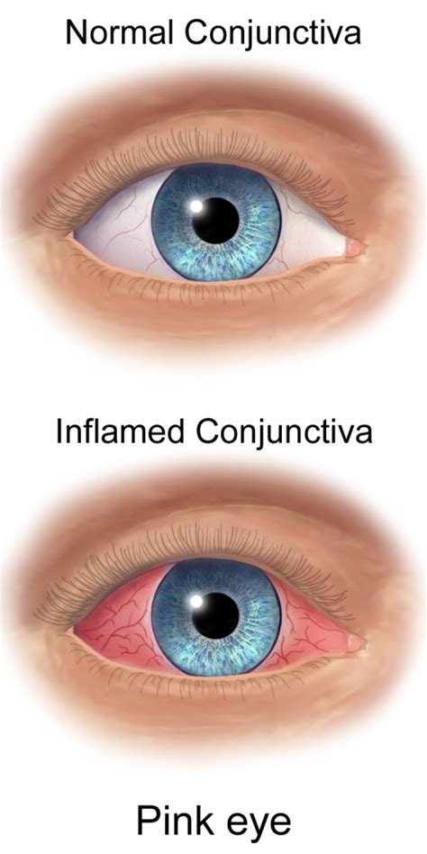 Conjunctival membrane