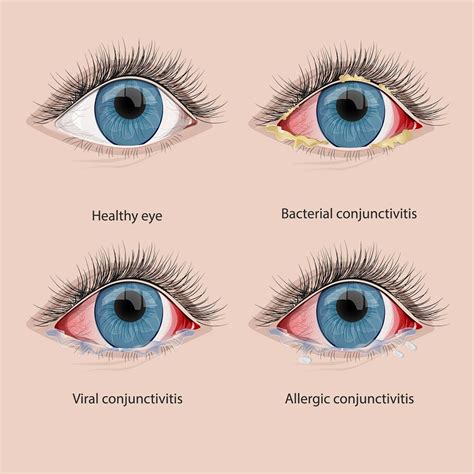 Conjunctivitis symptoms