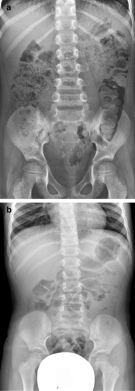 Constipation X-ray Signs