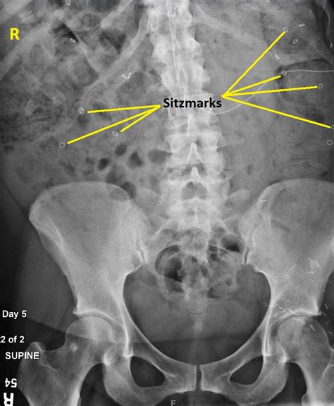 Constipation X-ray Signs