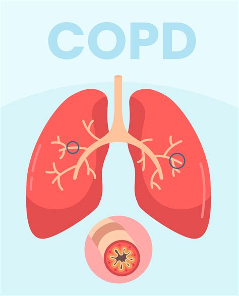 COPD Overview