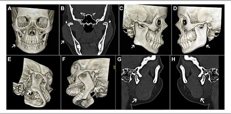 Cosmetic Osteoplasty