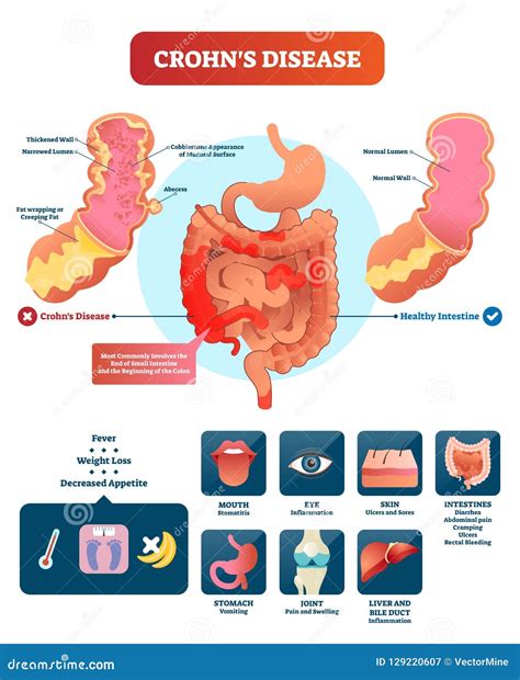 Abscess in Crohn's disease