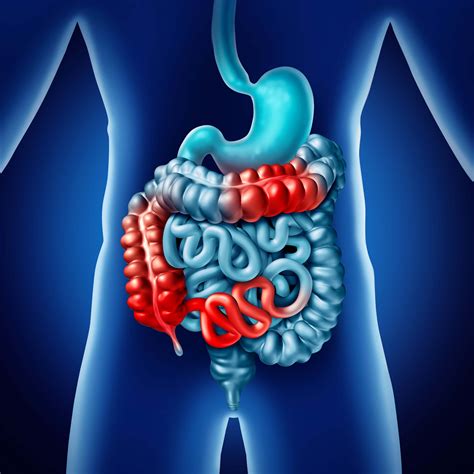 Bowel obstruction in Crohn's disease