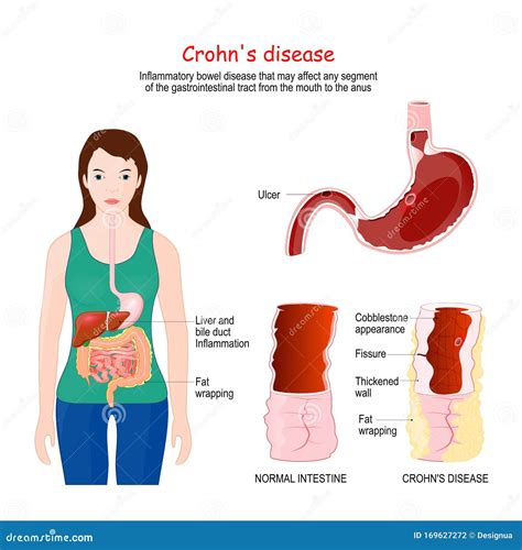 Diarrhea in Crohn's disease