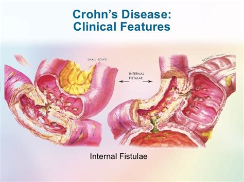 Fistula in Crohn's disease