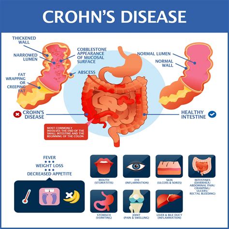 Pain management in Crohn's disease