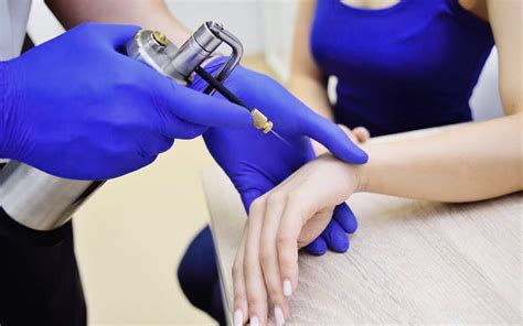 Cryotherapy for Wart Removal