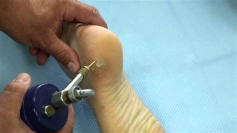 Cryotherapy for wart removal