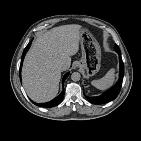 CT abdomen scan image