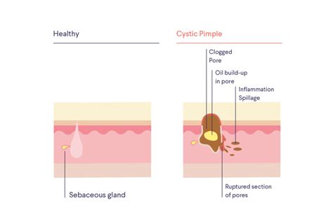 Cyst or abscess