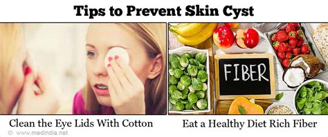 Cyst Prevention Tips