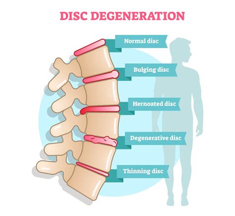 Degenerative disc disease illustration