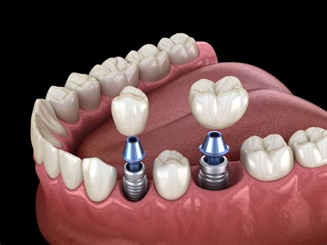 Dental implants