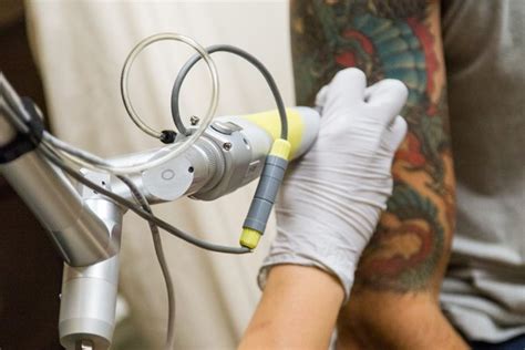 Denver CO tattoo removal