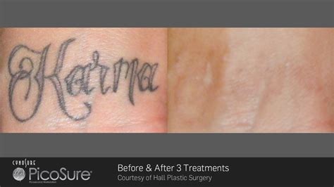 Dermabrasion and chemical peels tattoo removal