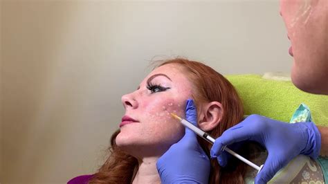 Dermal Fillers for Scars