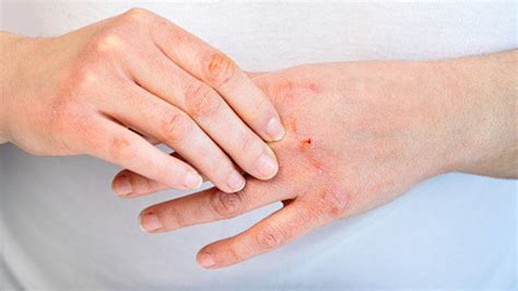 Detergent allergy rash symptoms